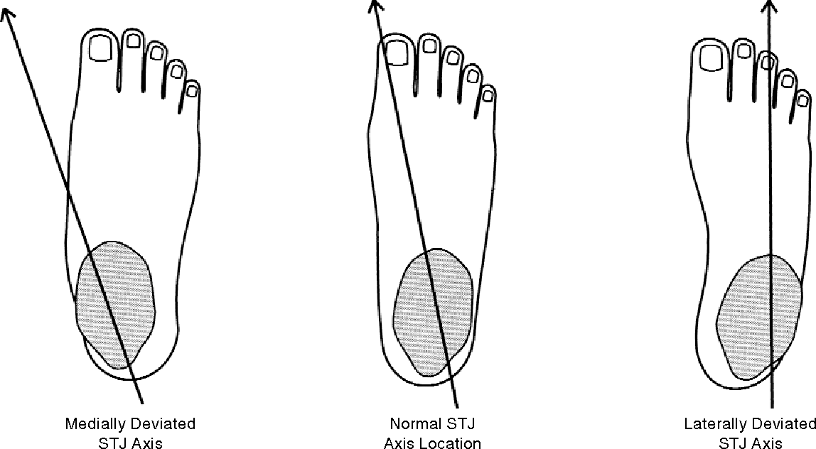 Normal And Abnormal Feet